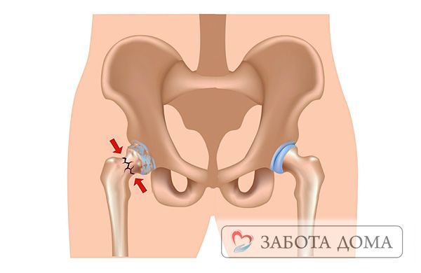Перелом шейи бедра у пожилых людей